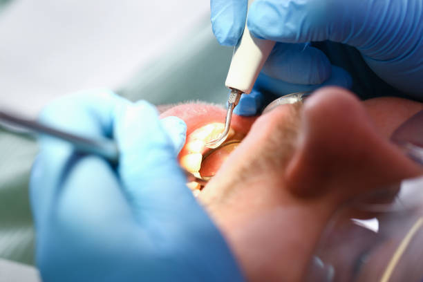 Best Knocked-Out Tooth (Avulsed Tooth) Treatment in Sterling, CO
