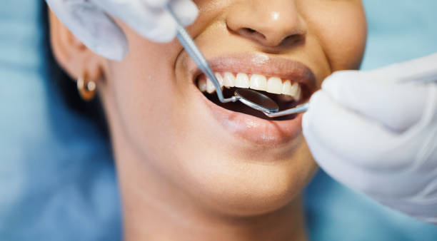 Best Emergency Wisdom Tooth Extraction in Sterling, CO