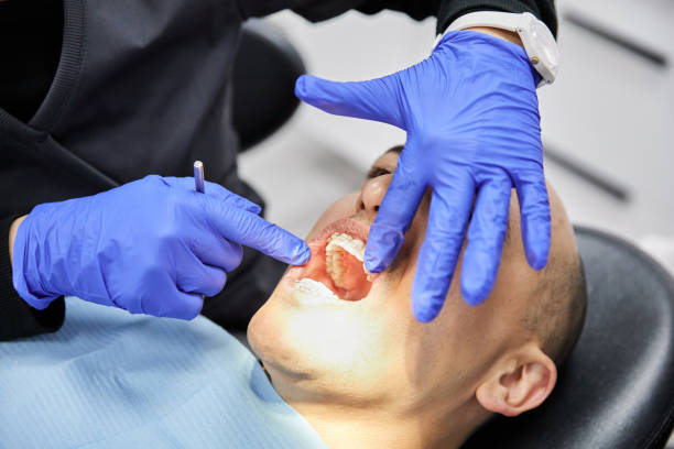 Best Emergency Wisdom Tooth Extraction in Sterling, CO